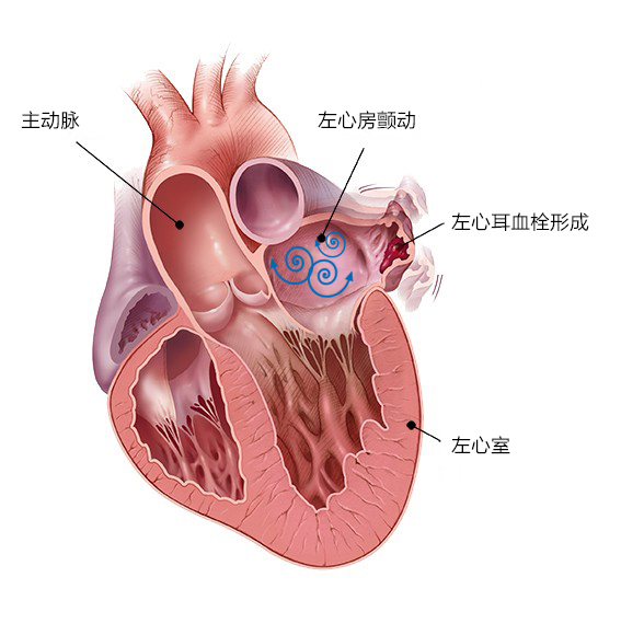 先健科技左心耳封堵器系统获得欧盟ce 认证